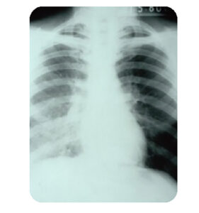 A lung infected with legionella